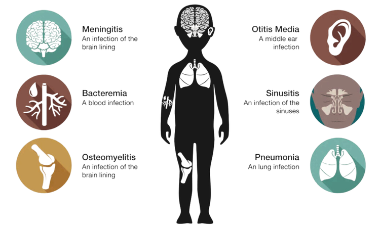 Invasive Pneumococcal Disease