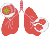 Chronic lung or respiratory disease