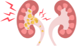 End-stage renal disease